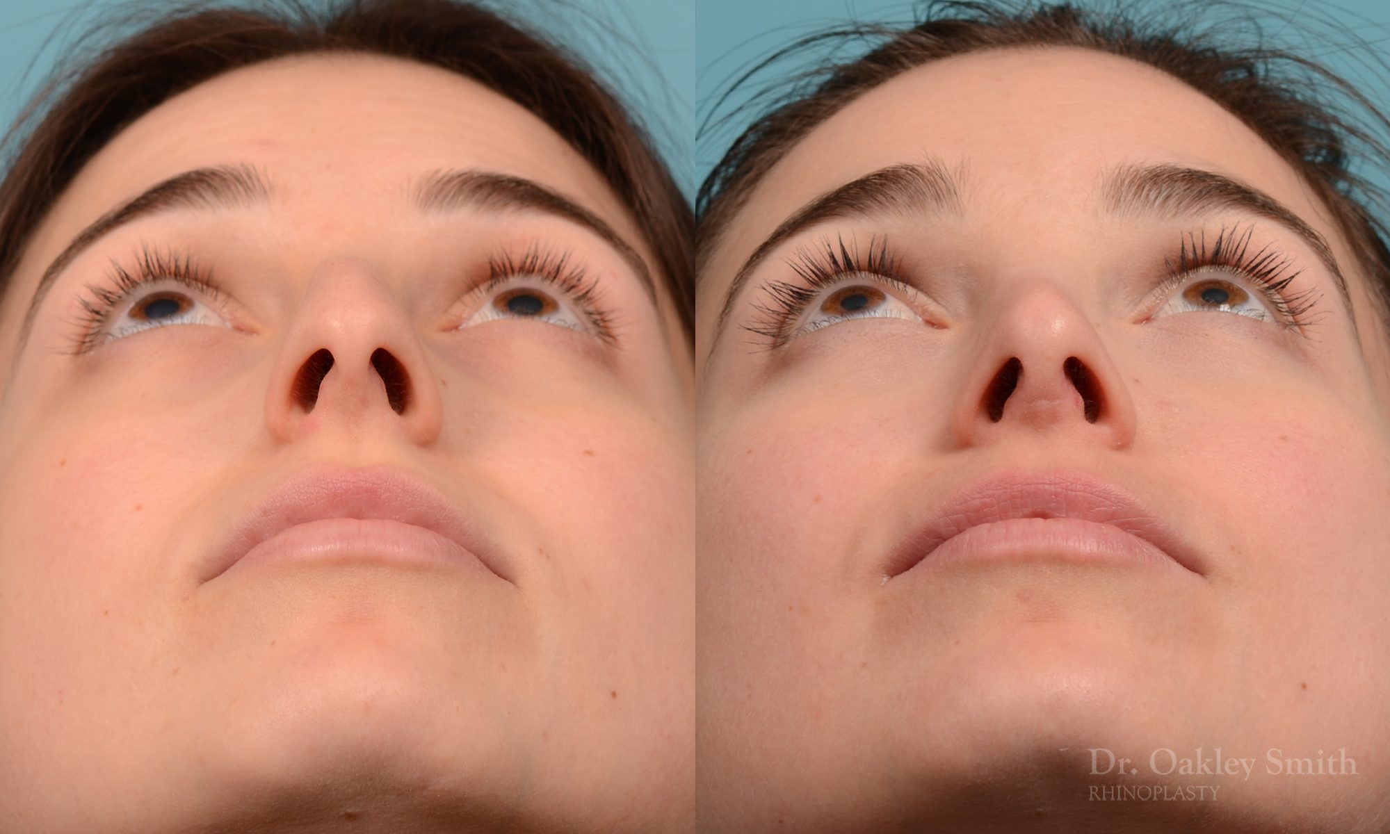 Severe rhinoplasty with hump reduction