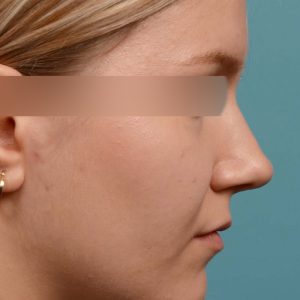 rhinoplasty smooth tip