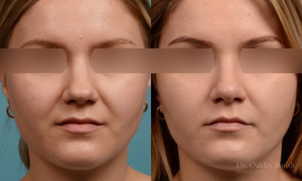 rhinoplasty smooth tip