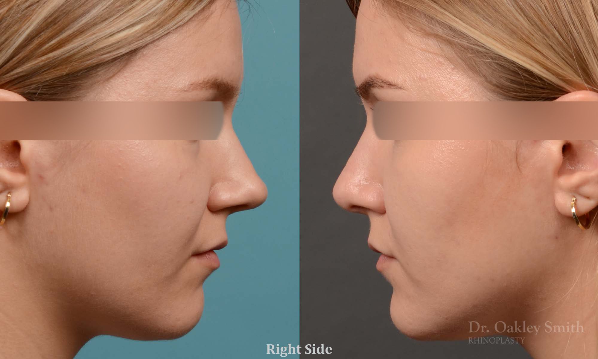 rhinoplasty smooth tip