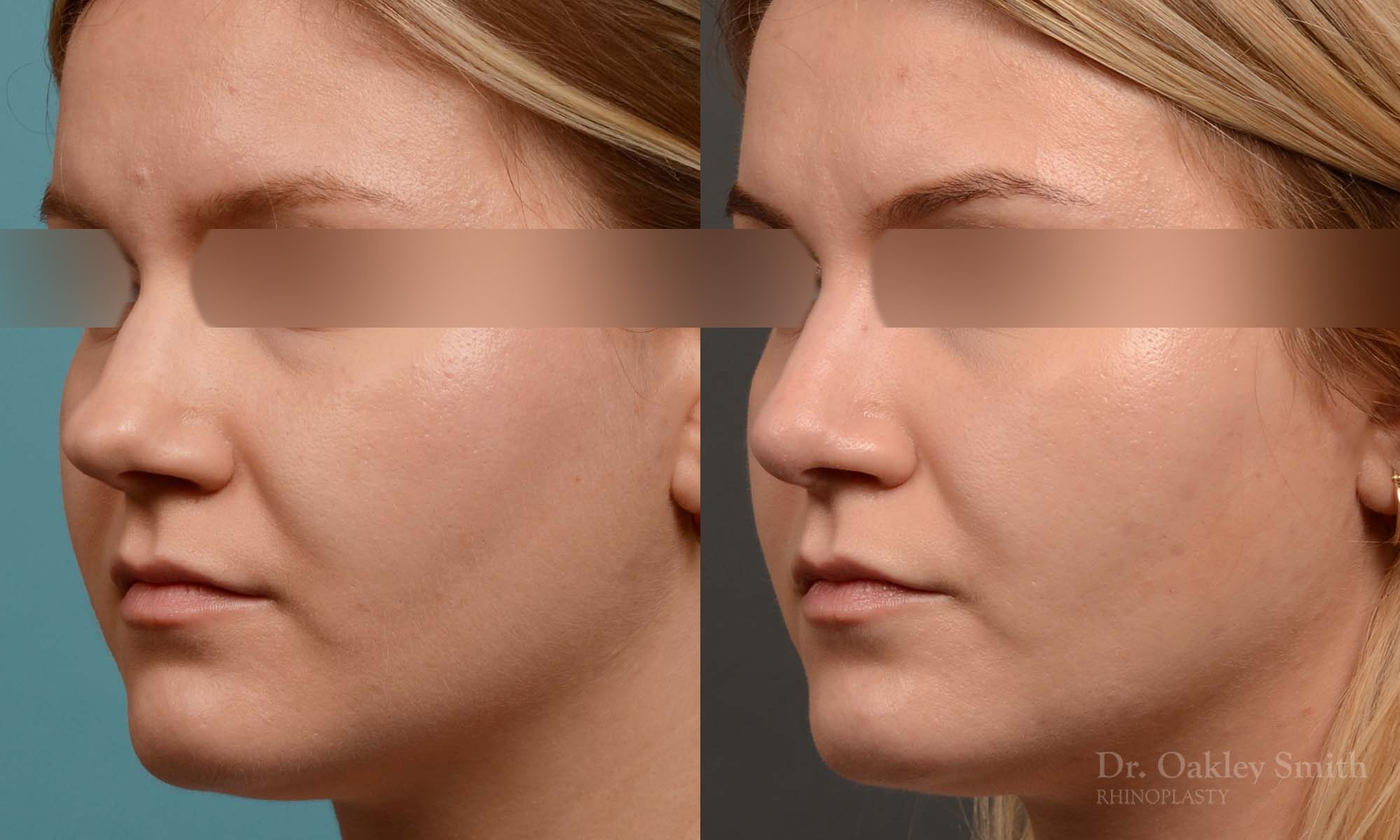 rhinoplasty smooth tip