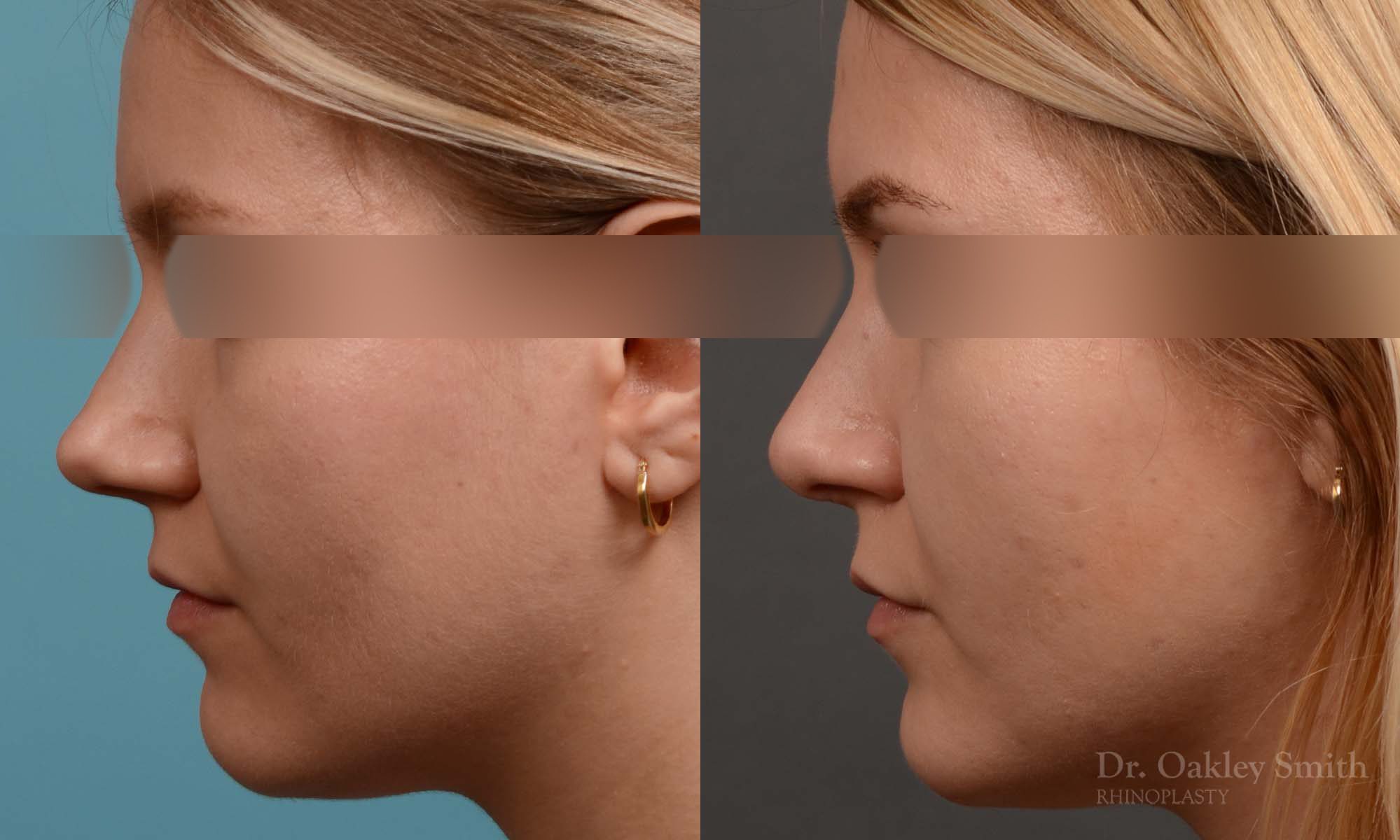 rhinoplasty smooth tip