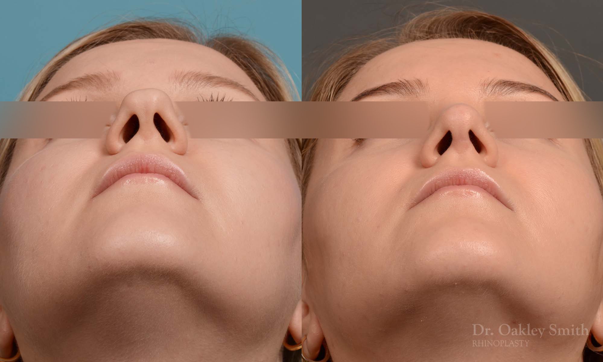 rhinoplasty smooth tip