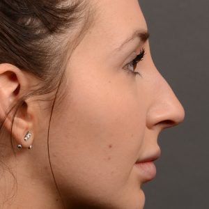 Nose job to create a smoother nose!