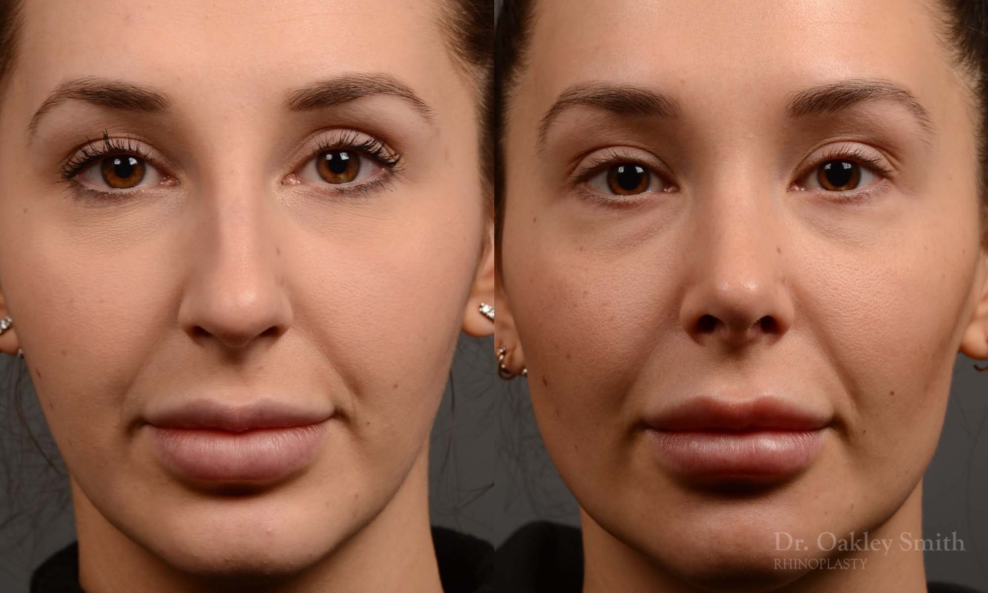 rhinoplasty Nothing demonstrates the skillful craftsmanship that Dr. Oakley Smith accomplishes during his surgeries than a collection of before and after case studies. As one of a hand full of surgeons in North America who limits his practice to only Rhinoplasty surgery, it is obvious that he has mastered his art. There is no question why he is one of the busiest cosmetic nose job surgeons in the country.