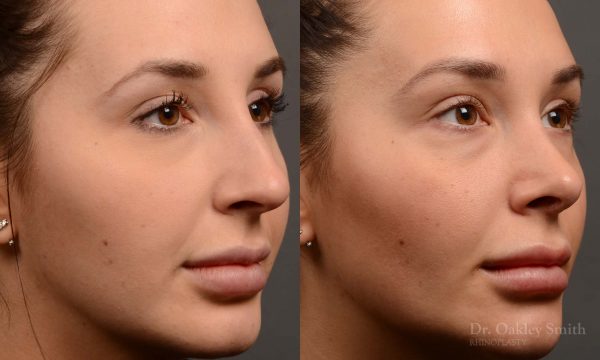 rhinoplasty Nothing demonstrates the skillful craftsmanship that Dr. Oakley Smith accomplishes during his surgeries than a collection of before and after case studies. As one of a hand full of surgeons in North America who limits his practice to only Rhinoplasty surgery, it is obvious that he has mastered his art. There is no question why he is one of the busiest cosmetic nose job surgeons in the country.