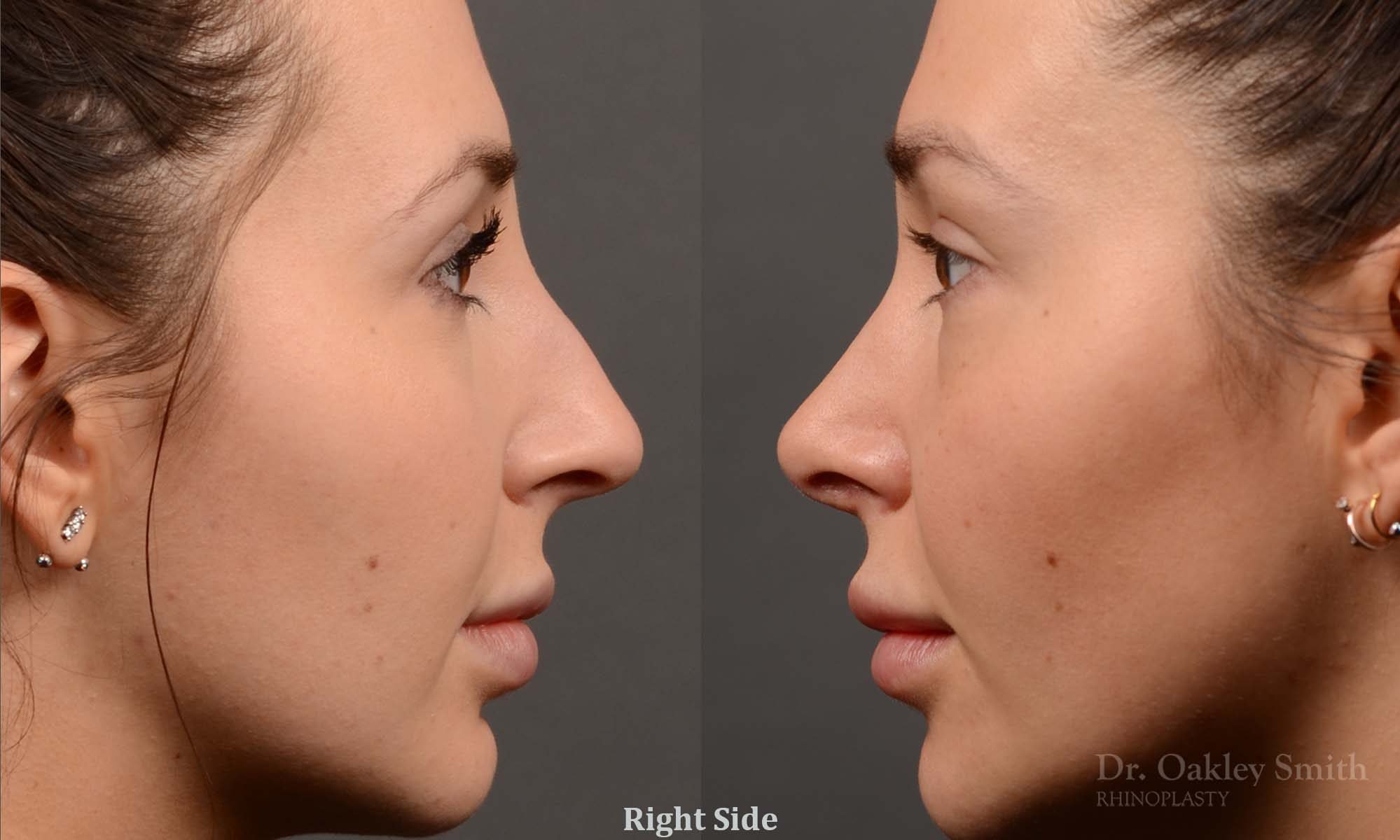 rhinoplasty Nothing demonstrates the skillful craftsmanship that Dr. Oakley Smith accomplishes during his surgeries than a collection of before and after case studies. As one of a hand full of surgeons in North America who limits his practice to only Rhinoplasty surgery, it is obvious that he has mastered his art. There is no question why he is one of the busiest cosmetic nose job surgeons in the country.