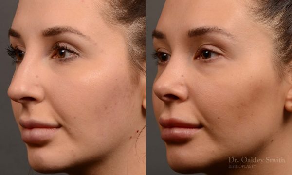 rhinoplasty Nothing demonstrates the skillful craftsmanship that Dr. Oakley Smith accomplishes during his surgeries than a collection of before and after case studies. As one of a hand full of surgeons in North America who limits his practice to only Rhinoplasty surgery, it is obvious that he has mastered his art. There is no question why he is one of the busiest cosmetic nose job surgeons in the country.