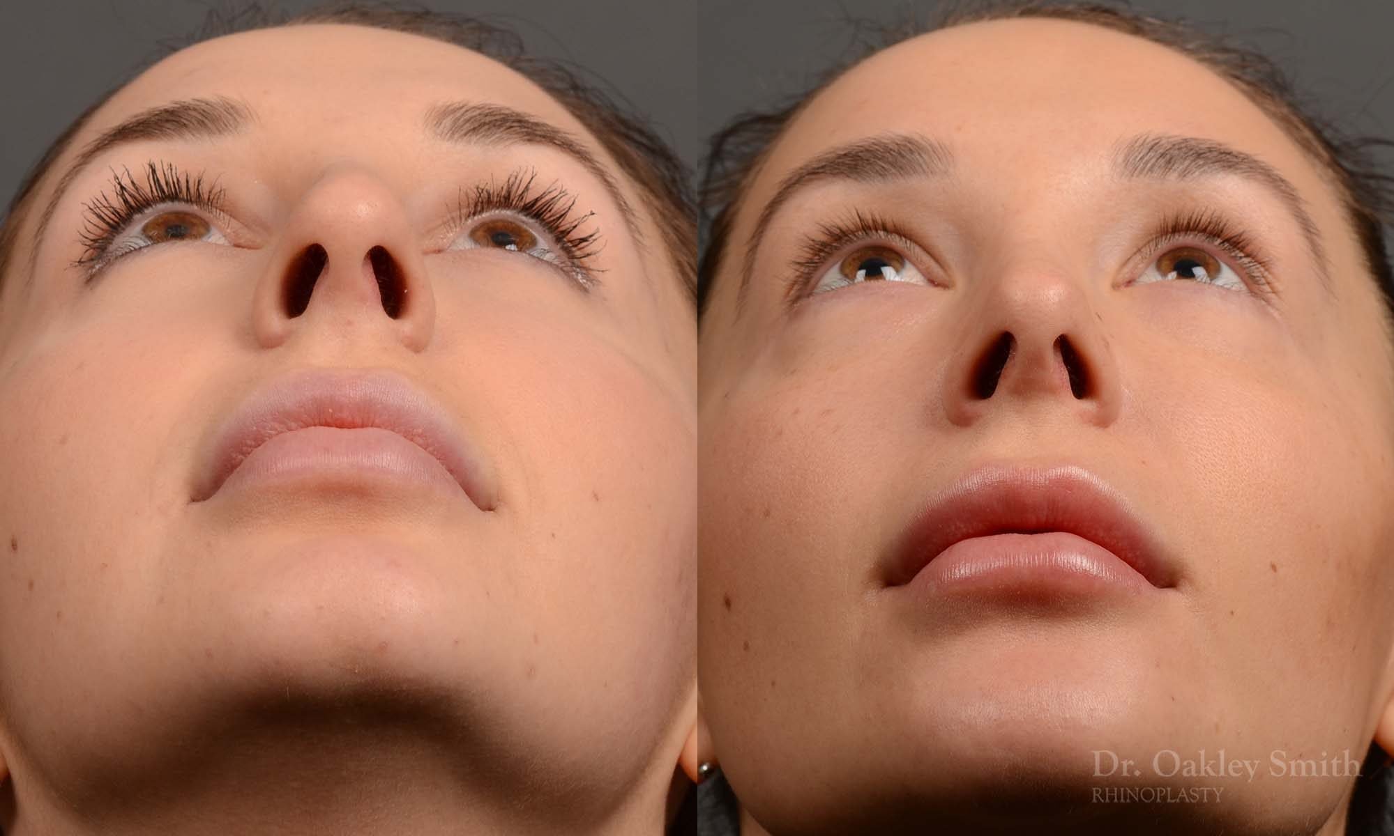 rhinoplasty Nothing demonstrates the skillful craftsmanship that Dr. Oakley Smith accomplishes during his surgeries than a collection of before and after case studies. As one of a hand full of surgeons in North America who limits his practice to only Rhinoplasty surgery, it is obvious that he has mastered his art. There is no question why he is one of the busiest cosmetic nose job surgeons in the country.