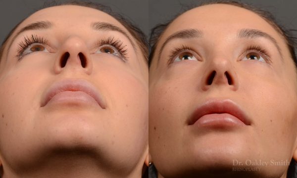 rhinoplasty Nothing demonstrates the skillful craftsmanship that Dr. Oakley Smith accomplishes during his surgeries than a collection of before and after case studies. As one of a hand full of surgeons in North America who limits his practice to only Rhinoplasty surgery, it is obvious that he has mastered his art. There is no question why he is one of the busiest cosmetic nose job surgeons in the country.