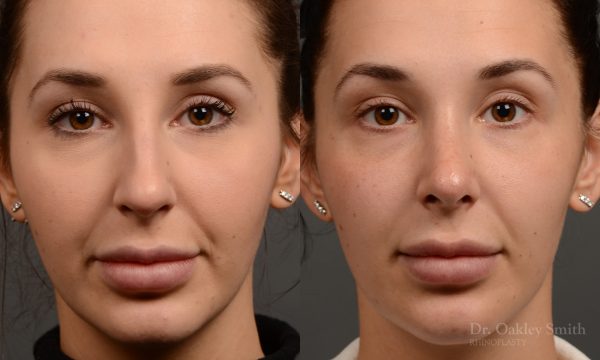 Nose job to create a smoother nose!