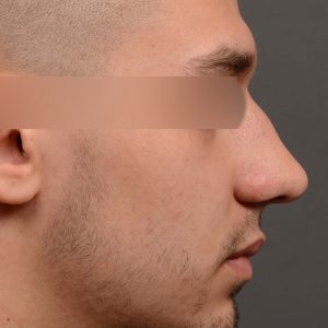 Male rhinoplasty bump on nose