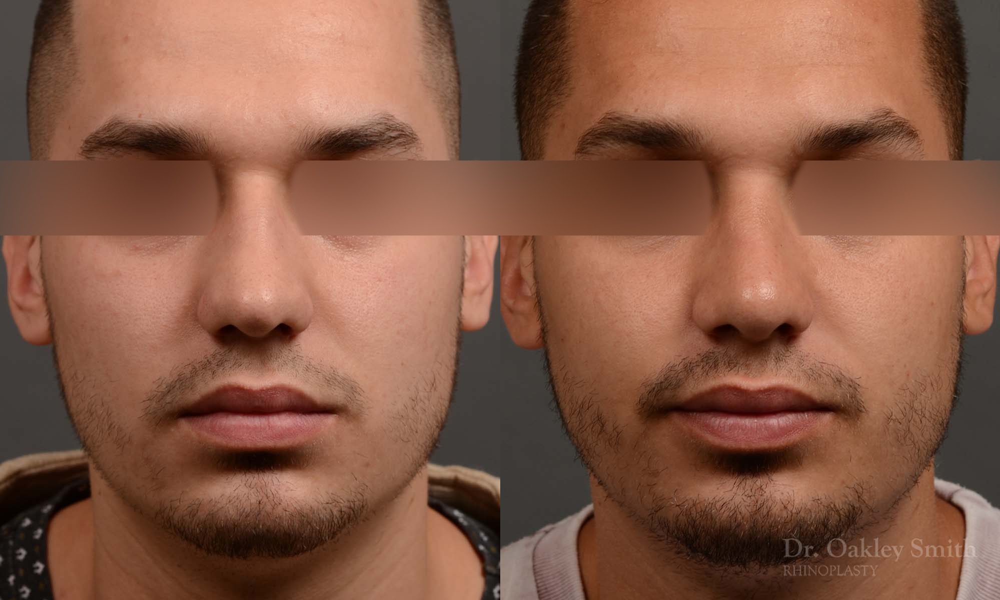 Male rhinoplasty bump on nose
