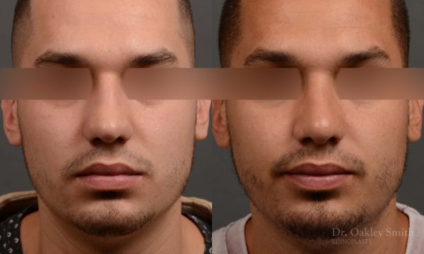 Male rhinoplasty bump on nose