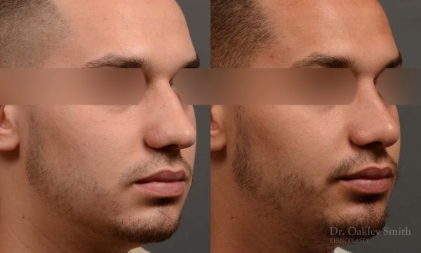 Male rhinoplasty bump on nose