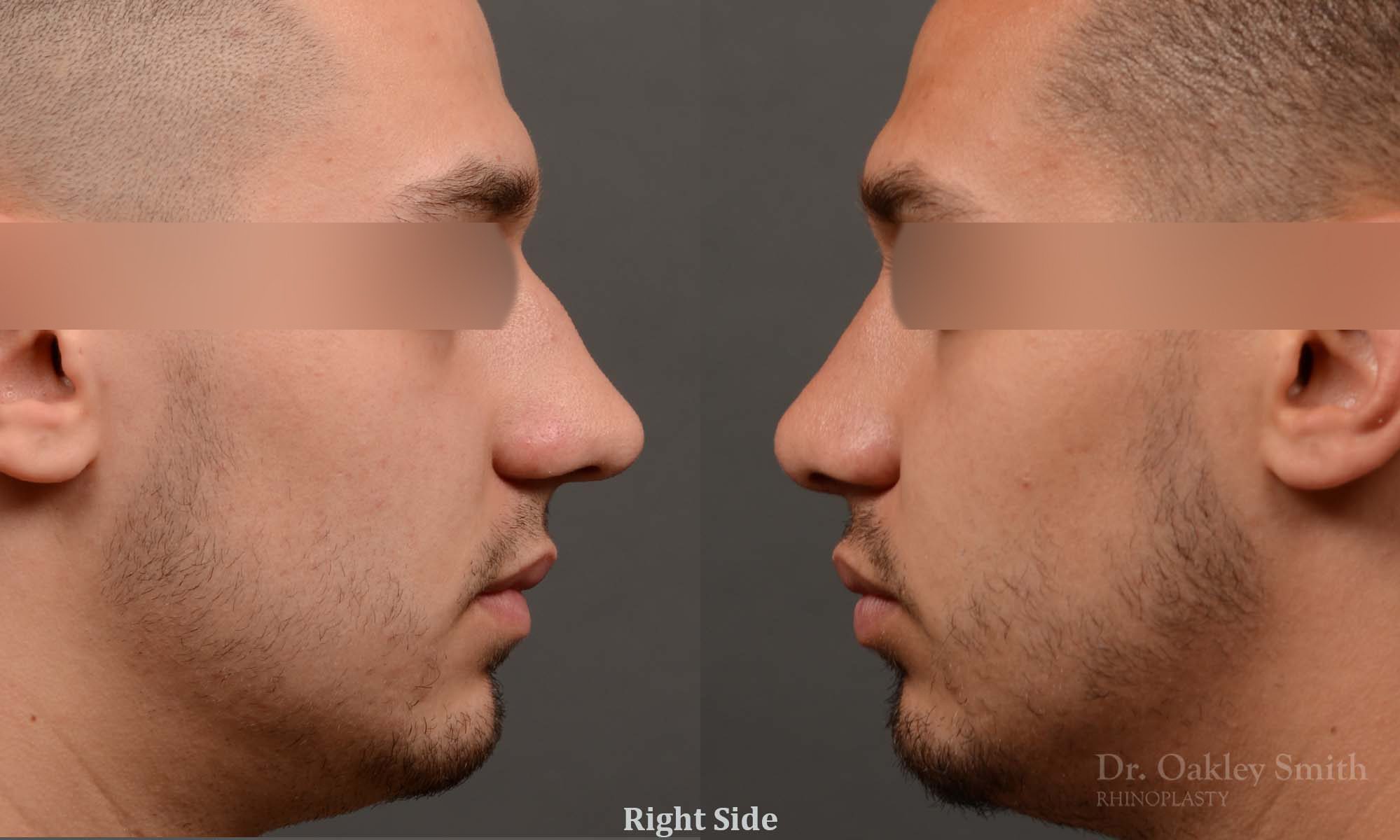 Male rhinoplasty bump on nose