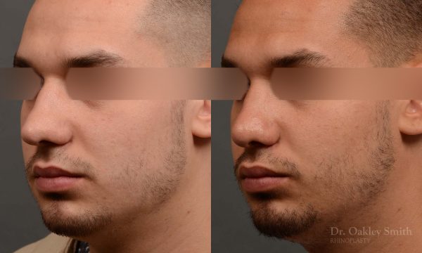 Male rhinoplasty bump on nose