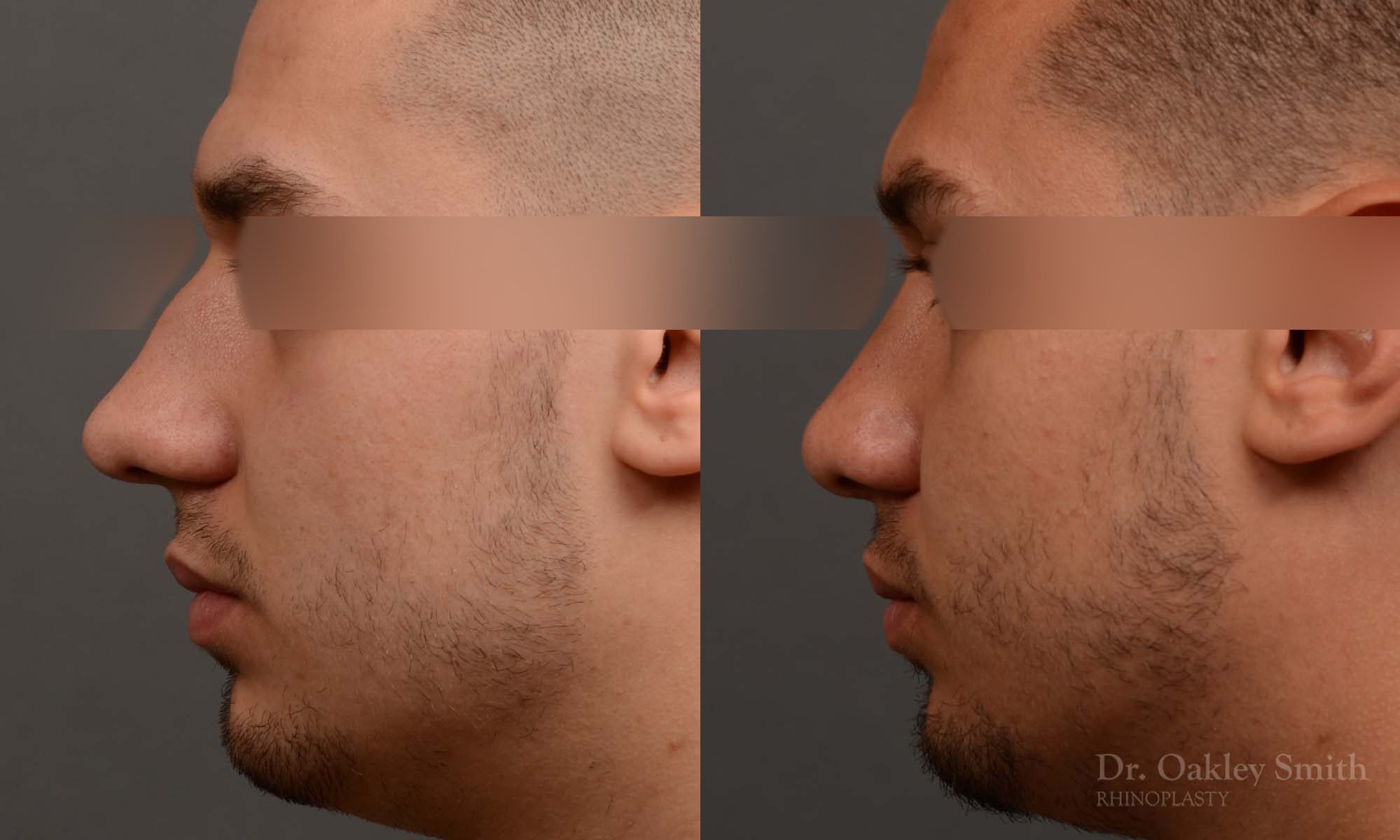 Male rhinoplasty bump on nose