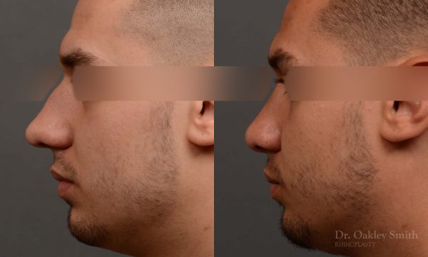 Male rhinoplasty bump on nose