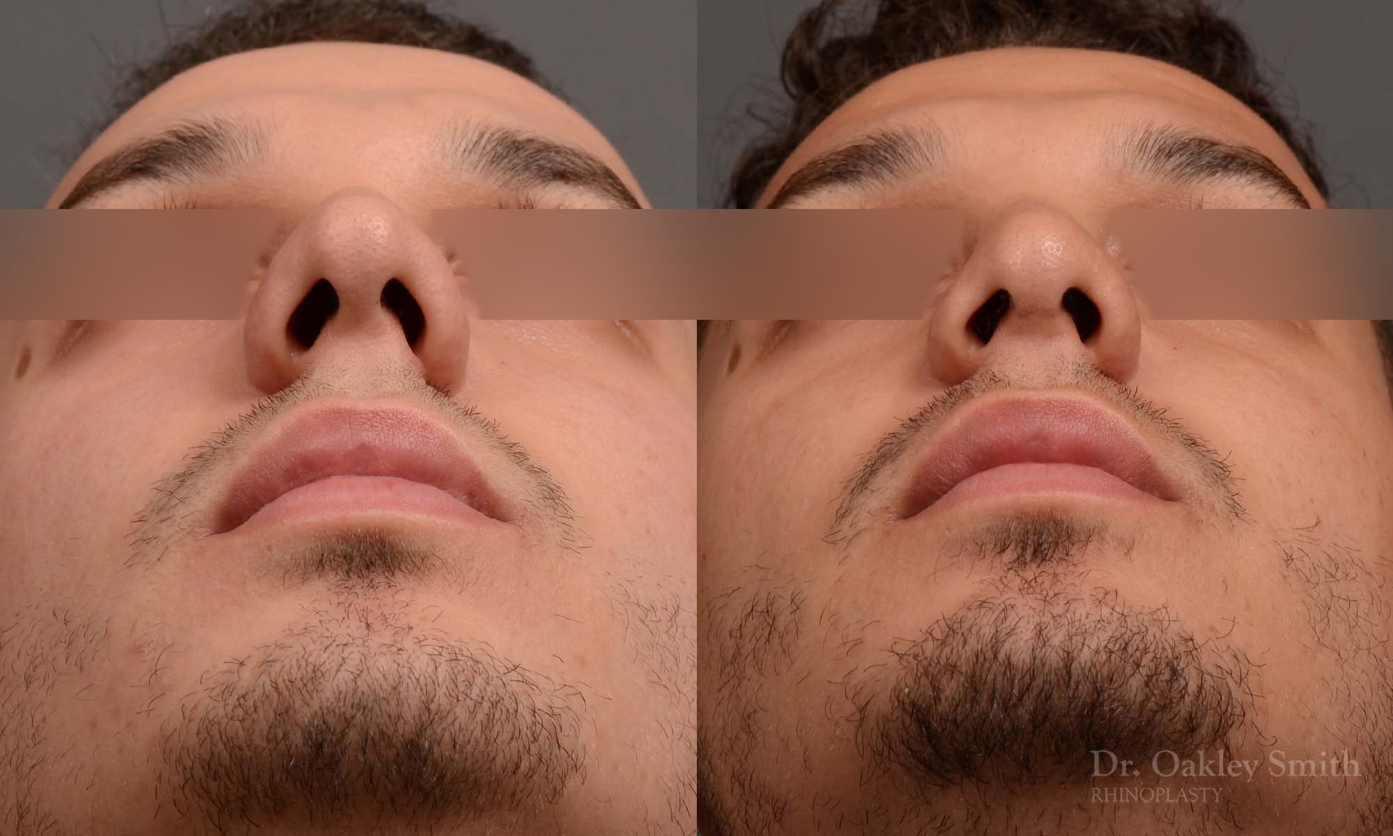 Male rhinoplasty bump on nose