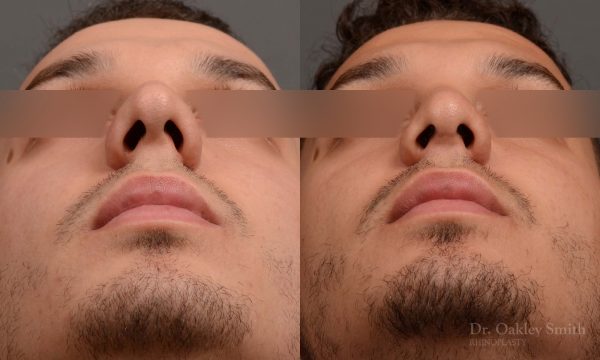 Male rhinoplasty bump on nose