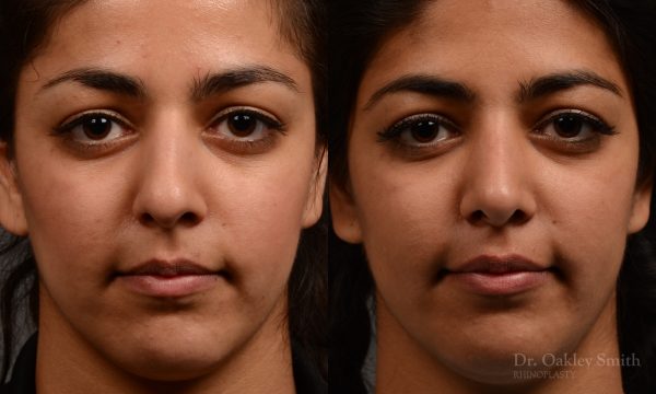 Rhinoplasty nose surgery