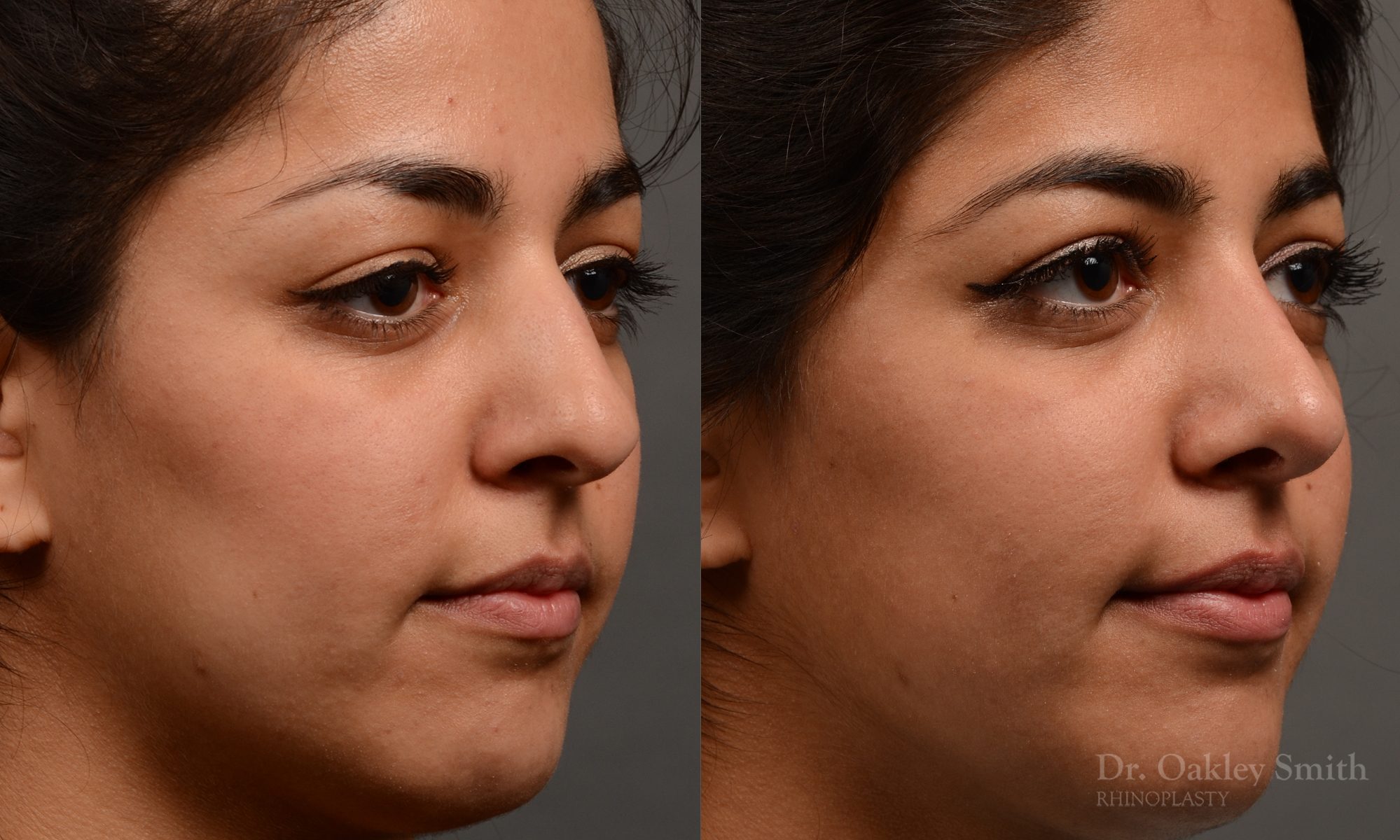 Rhinoplasty nose surgery