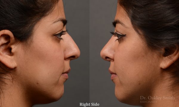 Rhinoplasty nose surgery