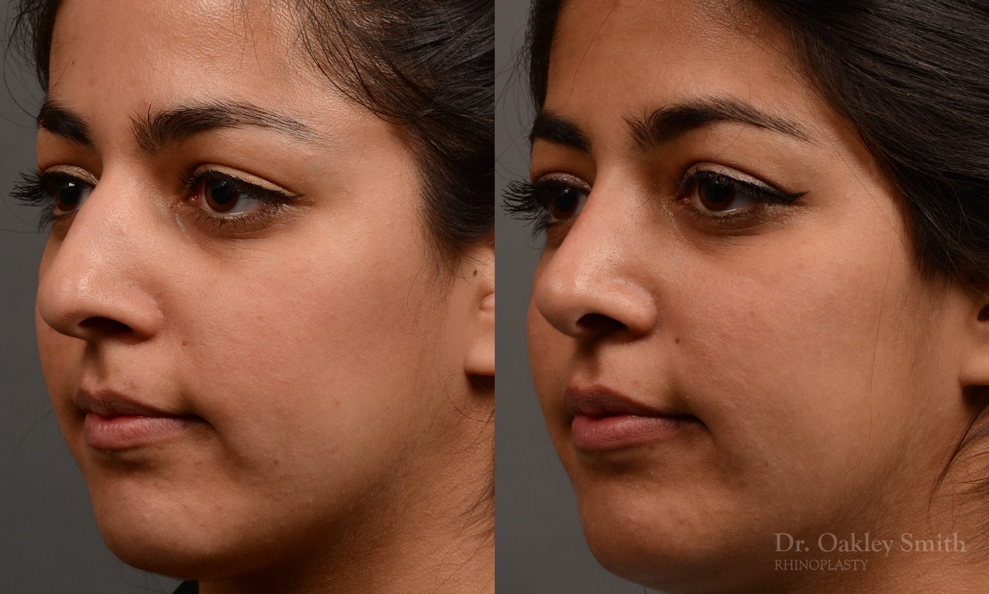 Rhinoplasty nose surgery