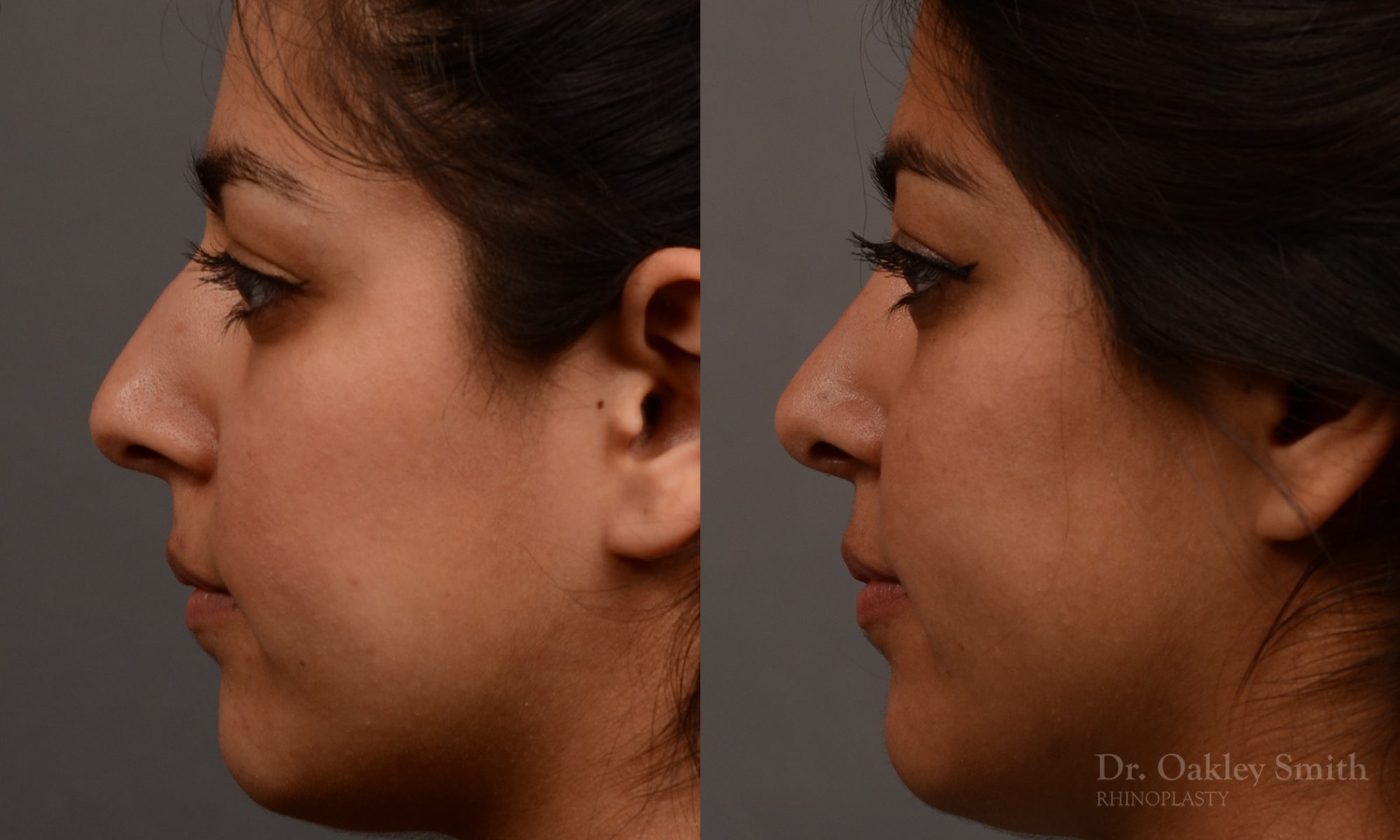 Rhinoplasty nose surgery