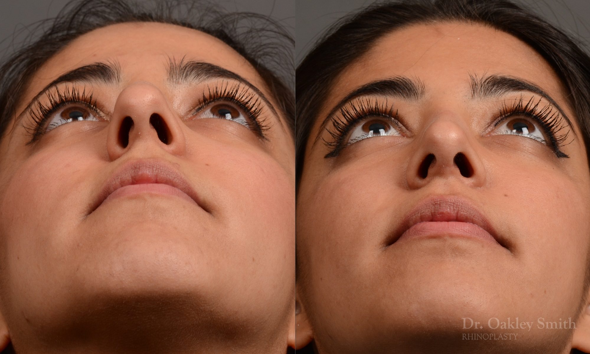 Rhinoplasty nose surgery