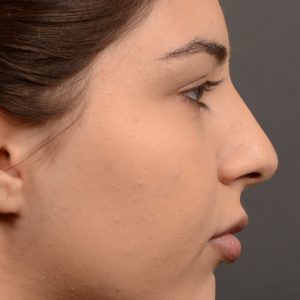 Rhinoplasty Feminine nose