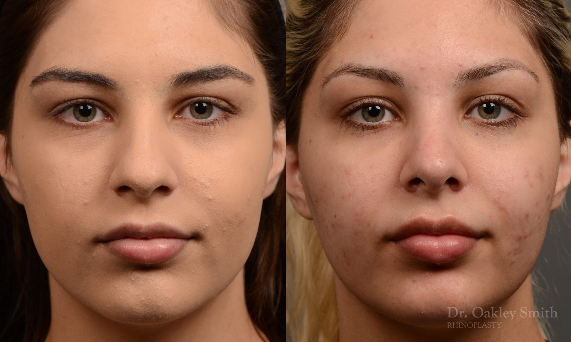Rhinoplasty Feminine nose
