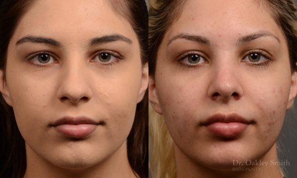 Rhinoplasty Feminine nose