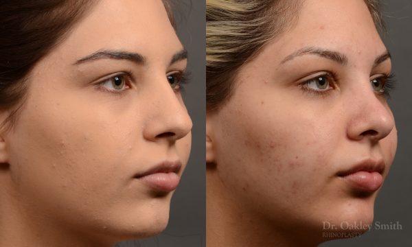 Rhinoplasty Feminine nose