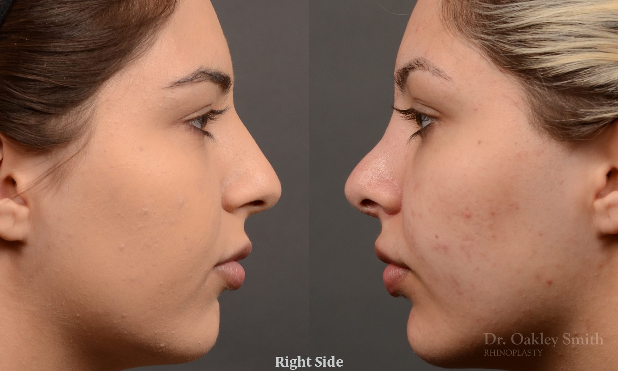 Rhinoplasty Feminine nose