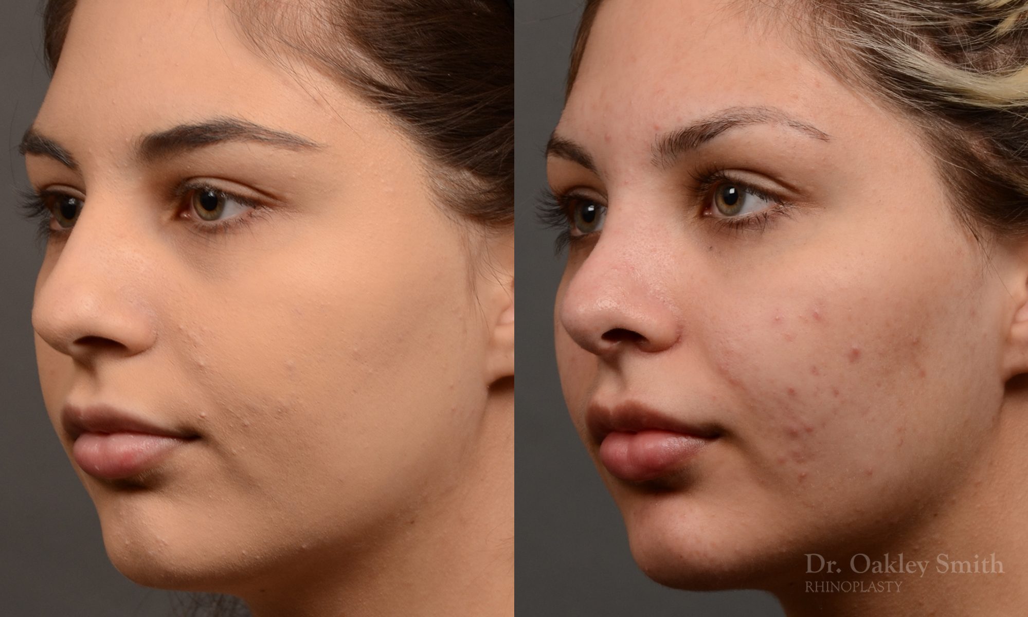 Rhinoplasty Feminine nose