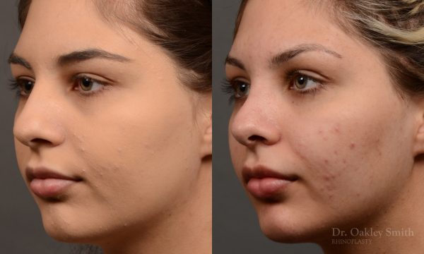 Rhinoplasty Feminine nose