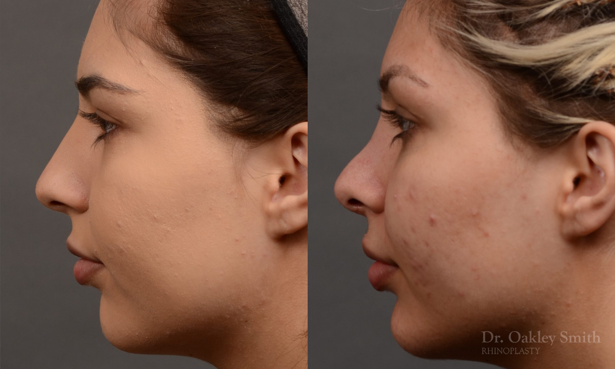 Rhinoplasty Feminine nose