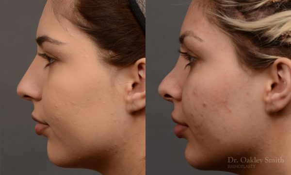 Rhinoplasty Feminine nose