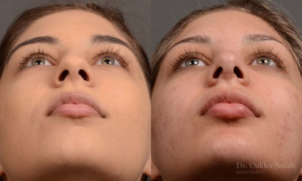 Rhinoplasty Feminine nose