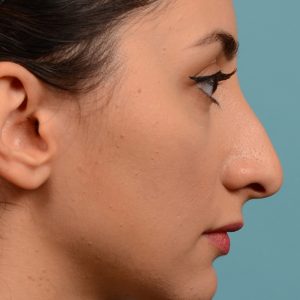 Rhinoplasty nose job female nose rhino reduction