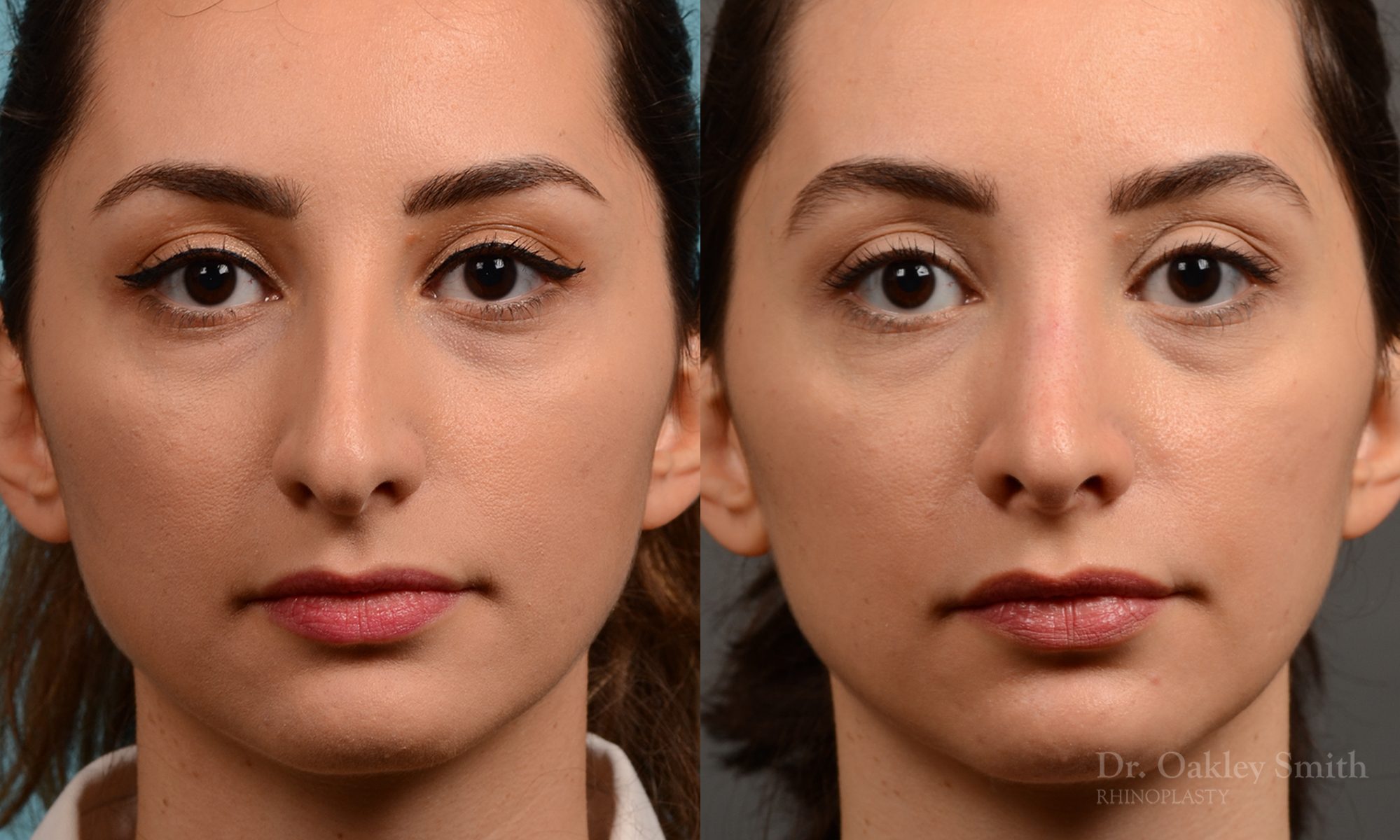 Rhinoplasty nose job female nose rhino reduction