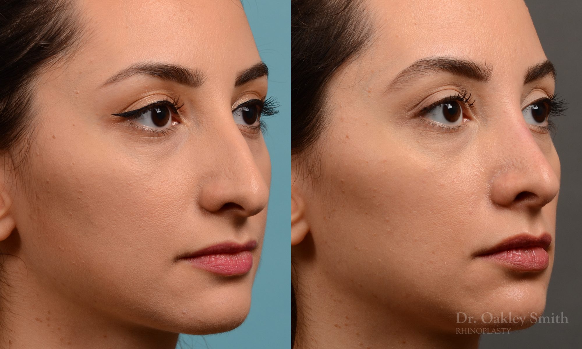 Rhinoplasty nose job female nose rhino reduction
