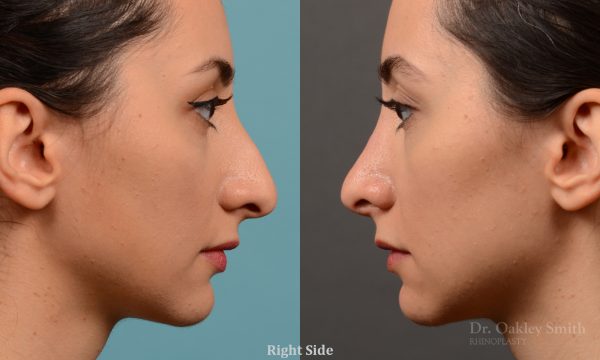 Rhinoplasty nose job female nose rhino reduction