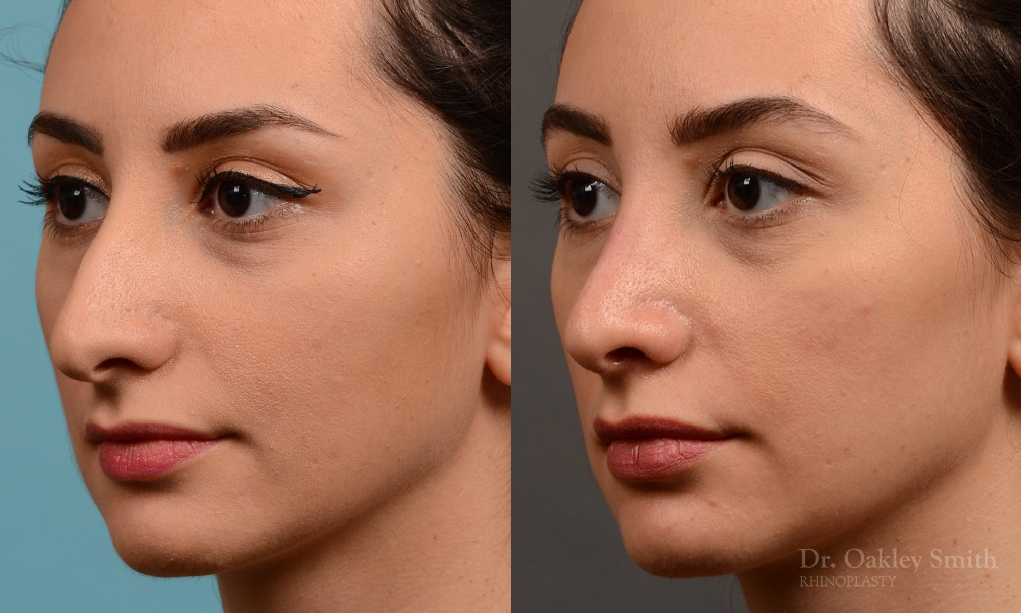 Rhinoplasty nose job female nose rhino reduction