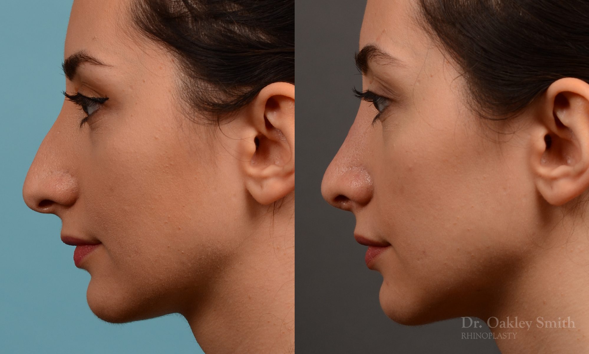 Rhinoplasty nose job female nose rhino reduction