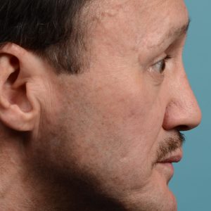 OHIP rhinoplasty for functional breathing
