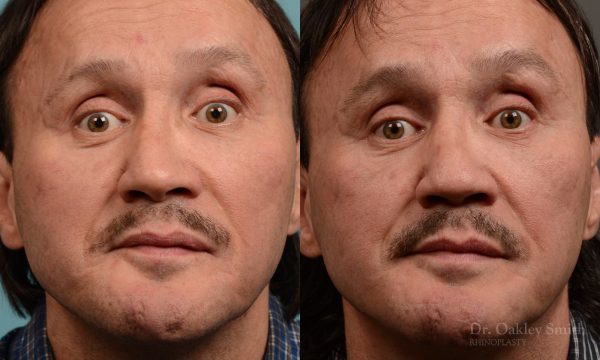 OHIP rhinoplasty for functional breathing