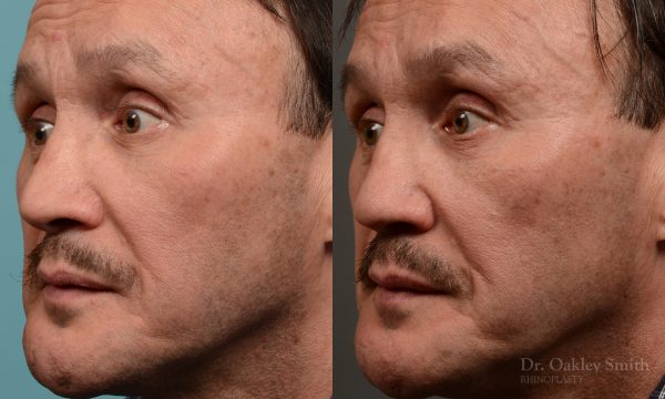 OHIP rhinoplasty for functional breathing